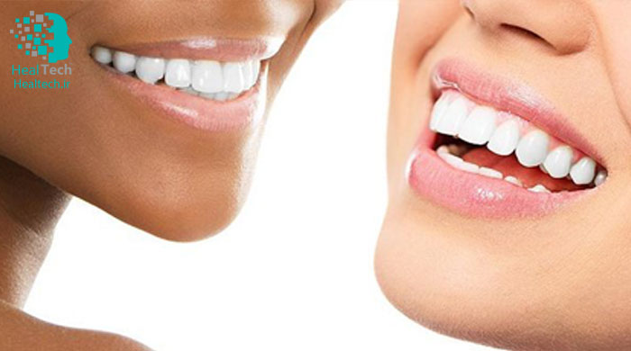 بلیچینگ دندان یا سفید کردن دندان