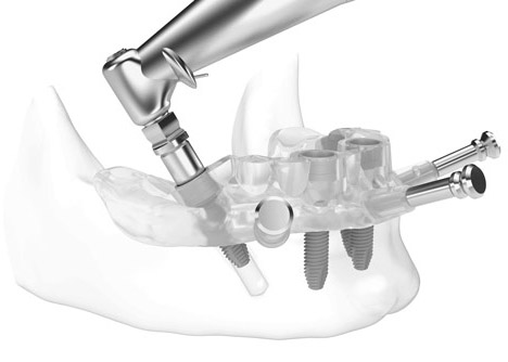 fully guided implant surgery
